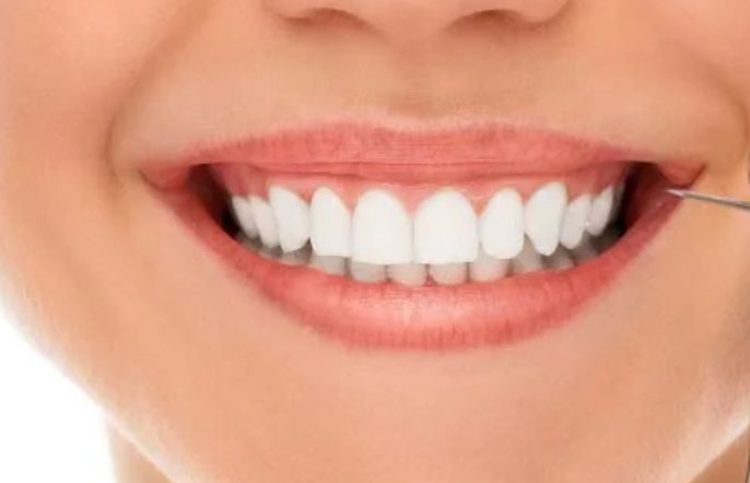 Răng sứ - mặt dán venner thẩm mỹ